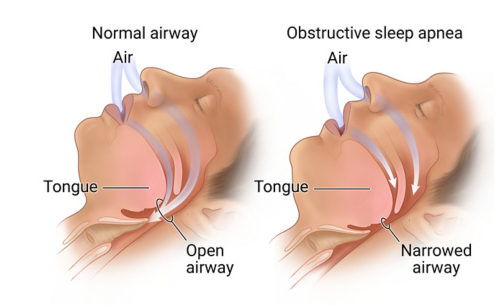 Effect of Bariatric Surgery-7