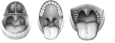 Tonsillecto