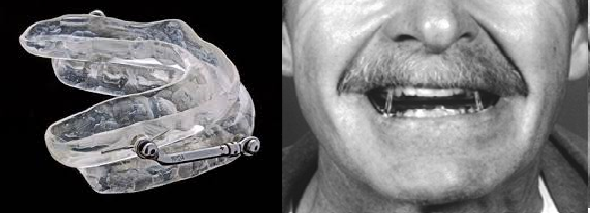 mandibular advancing devices (MADs)