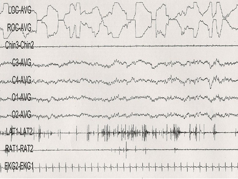 REM Parasomnia-2