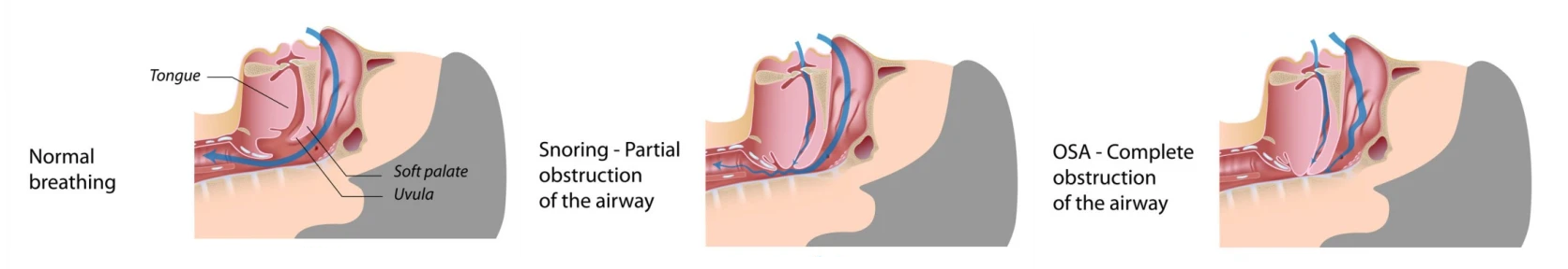 obstructive-sleep-apnea1-819x1024