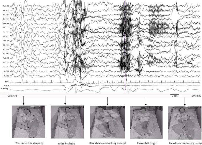 confusional Arousal EEG