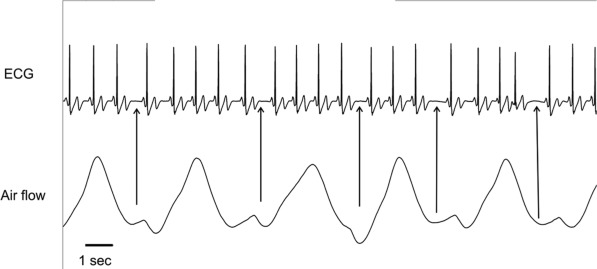 Arrhythmia-RES