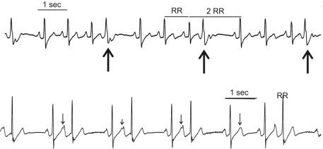 Atrial Premature Contractions