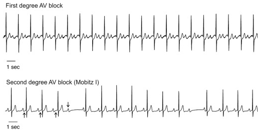 Mobitz Type 1.2
