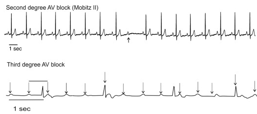Mobitz Type 2.3