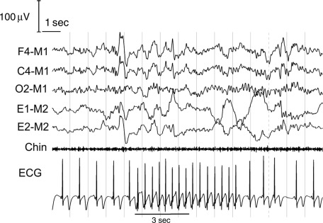 Narrow-complex tachycardia