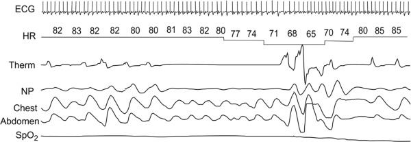 OSA ECG