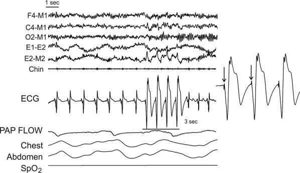 Wide-QRS-pacemaker