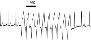 Wide-complex tachycardia