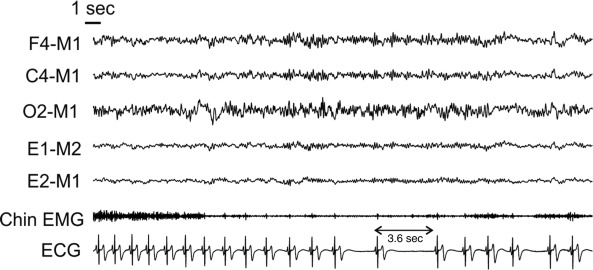 sinus arrest