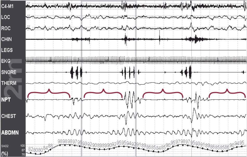 EEG SpO2