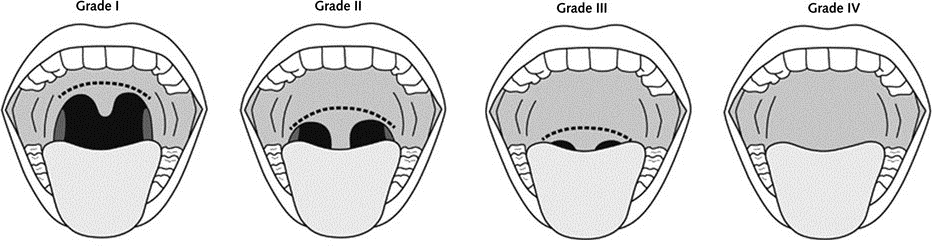 Mallampati score