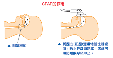 CPAP theyp